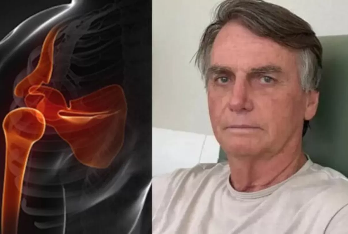Bolsonaro tem boa evolução após cirurgia no ombro e começará reabilitação
